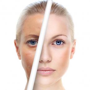 Pigmentation Removal